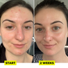 Boring Without You For Face Sake Multi-mask reduces blemishes in just two weeks. The ultimate skincare for combination skin.